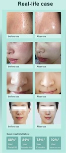 Appareil de beauté Hydra Dermabrasion 6 en 1 pour le visage, élimination des points noirs, rajeunissement de la peau, soin aqua peeling - Product Image 6