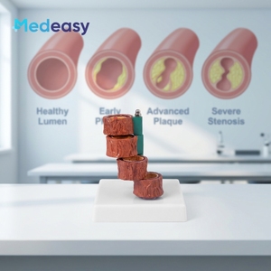 Modelo Anatómico Vascular de Cuatro Etapas de Medeasy Medical Science para el Estudio de la <span class=keywords><strong>Enfermedad</strong></span> de <span class=keywords><strong>Arteriosclerosis</strong></span> Humana - Product Image 4