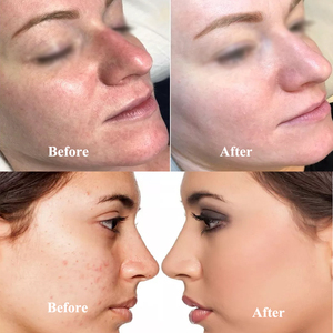 ชุดเซ็ตบำรุงผิวหน้า ZS Factory Price BB Booster Starter Kit รองพื้นกึ่งถาวร BB Foundation Pigment ผสมสารสกัด DNA ปลาแซลมอน เปปไทด์ ลดเลือนริ้วรอย - Product Image 6