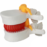 Modelo de demostración de enseñanza asistida, modelo de hernia de disco lumbar, modelo de disco intervertebral