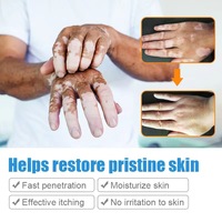 Salep Perawatan Bintik Putih Canggih Harga Pabrik untuk Kesehatan Pigmentasi Krim Herbal Profesional untuk Ekspor Global 20g