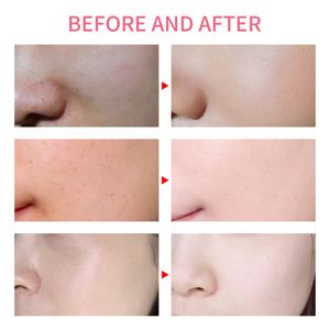 Sérum pour la peau à effet rapide, soin coréen, micro-aiguilletage cellulaire, sérum pour le visage, supérieur aux autres produits de soin de la peau (nouveau) - Product Image 5