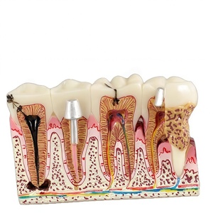 Modelo de Patología Dental, Modelo de Comunicación Paciente-Doctor, Modelo de Enseñanza de Salud Bucal, Resina - Product Image 4