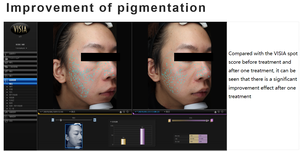 Alta calidad Etiqueta Privada 3ml * 5 Bootles profundo hidratante antiarrugas finos acné <span class=keywords><strong>mesoterapia</strong></span> suero <span class=keywords><strong>con</strong></span> ácido hialurónico - Product Image 6