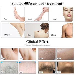 <span class=keywords><strong>2025</strong></span> mới đến thẩm mỹ y học <span class=keywords><strong>Laser</strong></span> vẻ đẹp thiết bị <span class=keywords><strong>laser</strong></span> 755nm 808nm 1064nm <span class=keywords><strong>Diode</strong></span> Máy tẩy lông bằng <span class=keywords><strong>laser</strong></span> - Product Image 5