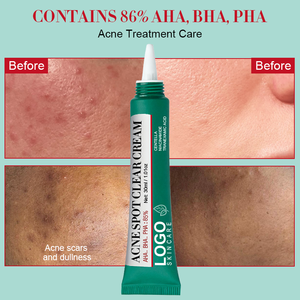 Crema para el Acné de Marca Privada que Combate las Espurros, Calma el Enrojecimiento, Hidrata Profundamente, Aclara las Marcas del Acné, Crema Suave para el Acné - Product Image 4