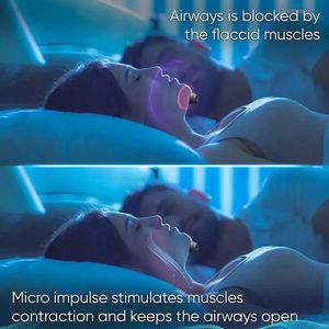 <span class=keywords><strong>2025</strong></span> phong cách mới thông minh chống ngáy Kit Silicone và nhựa mũi Clip ngủ yên tĩnh thiết bị cho nhà chăm sóc cho ngáy Stopper - Product Image 2