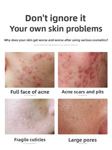 Suero Químico Profesional para Eliminar Cicatrices 5ml para Tratamiento del Acné <span class=keywords><strong>Facial</strong></span>, Exfoliación Profunda de la Piel - Product Image 6