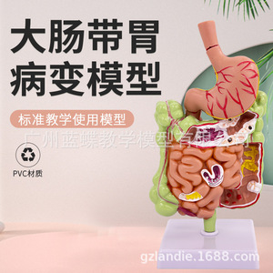 Modelo patológico del colon humano, modelo anatómico gastrointestinal, modelo patológico de colon, cecum, recto y duodeno - Product Image 1