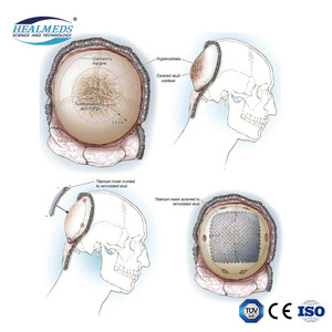 Malla de Titanio Médica para Injertos Óseos, Malla de Titanio Craneal Ortopédica con Forma de Nube Anatómica 3D para Cirugía Craneal - Product Image 3
