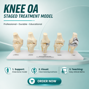 Modèle de comparaison d'implants totaux unicompartimentaux pour l'<span class=keywords><strong>arthrose</strong></span> du genou à 5 stades, modèle de traitement progressif - Product Image 5