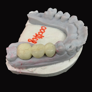 Restauración <span class=keywords><strong>fija</strong></span> Laboratorio dental asequible <span class=keywords><strong>Precio</strong></span> de China Puentes de corona de cerámica de metal <span class=keywords><strong>Precio</strong></span> barato Pfm - Product Image 6