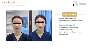 Realyse - Gel de Relleno Dérmico de Ácido Hialurónico Orgánico y Libre de Crueldad Animal de 1 ml para Rostro, Cuerpo, Labios y Nariz - Reafirmante y Antienvejecimiento OEM - Product Image 2