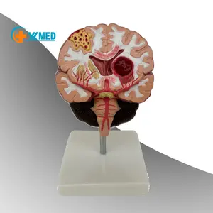 医療用人間の臓器の解剖学的解剖学的モデルは、脳卒中の解剖学的構造を示しています