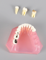 Modelo de Tratamiento de Caries con Puente de Caries e Implante