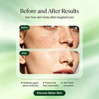 Crème Visage Anti-Acné Marque Blanche pour Peaux Grasses – Produits Cosmétiques à l'Acide Salicylique Hydratant et Réparateur