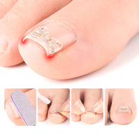 Correcteur d'ongles incarnés invisible en forme de X, léger, en alliage de nickel, auto-adhésif, pour l'hiver, vente en gros