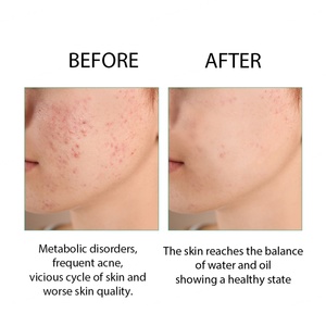 OEM ODM Private Label Soothing Hydrating <b>Moisturizing</b> Acnes Oil Control Tea Tree Facial Toner - Product Image 5