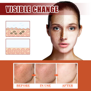 Élimination des cicatrices crème blanchissante pour le visage soins de la peau blanchissante crème blanchissante taches de rousseur élimination des taches crème de soin de la peau blanchissante éclaircissante - Product Image 4