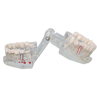 Modèle dentaire transparent d'implant dentaire, modèle de restauration de couronne et de pont amovible pour la démonstration pédagogique des dentistes