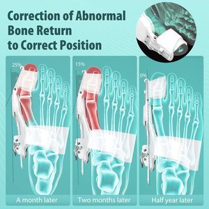 회색 <span class=keywords><strong>Bunion</strong></span> 교정기 여성 남성 정형 <span class=keywords><strong>Bunion</strong></span> 보정 편안한 조정 가능한 엄지 발가락 분리기 <span class=keywords><strong>Bunion</strong></span> 부목 나일론 - Product Image 2