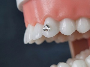 Gioielli Dentali a Forma di Cuore in Cristallo - Gemme Dentali Premium per un <span class=keywords><strong>Sorriso</strong></span> Scintillante, Gioielli in <span class=keywords><strong>Stile</strong></span> Hip Hop Punk - Product Image 2