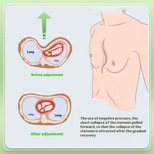 Meilleures ventes : Cloches de compression sous vide à moule exclusif pour le traitement non chirurgical du pectus excavatum (poitrine encastrée), Fabriqué en Chine, Modèle/Marque : Autre - Product Image 3