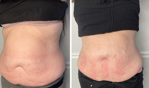 Máquina de liposucción láser 5D Diodo Láser Quema de grasa Anticelulitis Estiramiento DE LA PIEL Almohadillas láser Dispositivo de terapia no invasiva - Product Image 4