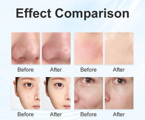 Dispositivo Portátil 3 en 1 de Oxígeno para Salón de Belleza, Hidrodermoabrasión, Terapia de Oxígeno, Máquina Facial de Burbujas de Oxígeno para Spa - Product Image 5