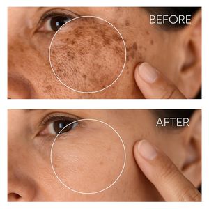 Crema Blanqueadora Antipekas y Antimanchas en 14 Días, Potente y Fuerte con Vitamina C y Ácido Kójico, Crema en Sérum para la Eliminación de Manchas Oscuras - Product Image 4