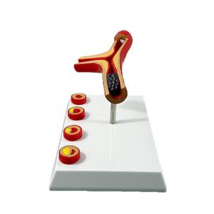 Modèle de blocage des vaisseaux sanguins en anatomie humaine LYA-002, concentration sanguine, <span class=keywords><strong>pathologie</strong></span> des graisses, atherosclérose, <span class=keywords><strong>pathologie</strong></span> <span class=keywords><strong>vasculaire</strong></span> - Product Image 5