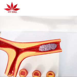 Anatomie humaine Artère et vaisseaux sanguins athérosclérose Modèle de <span class=keywords><strong>pathologie</strong></span> thrombus médical - Product Image 3