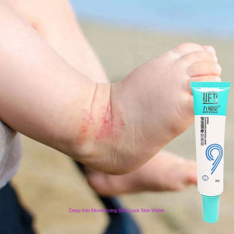 L eczema cream use before but doesn't itch not red no allergies skin not dry