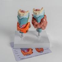 Modèle d'anatomie pathologique thyroïdienne médicale pour l'enseignement et la démonstration