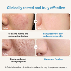 Suero para el Tratamiento del Acné con Mejora de la Piel en 4 Semanas, Reduce el 90% de las Imperfecciones de la Piel, Refina los Poros y Suaviza la Piel Áspera - Product Image 6