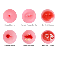 Outils pédagogiques gynécologiques : Ensemble de modèles de l'utérus et du col de l'utérus féminin, niveaux 1 à 6, modèles de pathologie cervicale avec boîte en bois