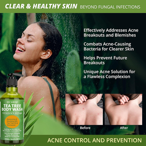 OEM Natural Herbal Hombres y Mujeres Árbol de Té Antihongos Gel de Ducha <span class=keywords><strong>PARA</strong></span> EL <span class=keywords><strong>Tratamiento</strong></span> del Acné de Espalda - Product Image 2