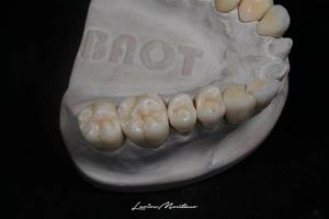 Baot ชุดเซรามิกเซอร์โคเนียขนาดเล็กวัสดุเพื่อสุขภาพทางทันตกรรมผงเซรามิกคอมโพสิตวัสดุพอร์ซเลนสำหรับทันตกรรม - Product Image 6