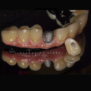 Implantes personalizados Solución de reemplazo dental Implantes dentales con el cuidado adecuado - Product Image 4