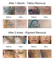 PicoKing 350ps Real Picolaser Professionnel 532nm 755nm 1064nm 1320nm Machine d'élimination des tatouages avec certification médicale CE