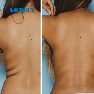 Laser chirurgical 2026 1470nm pour lifting du visage, élimination du double <span class=keywords><strong>menton</strong></span> et des poches sous les yeux / Appareil laser de lipolyse - Product Image 6