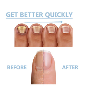 Soin des ongles et des pieds contre les mycoses, traitement <span class=keywords><strong>antifongique</strong></span> pour les ongles, essence anti-infection pour l'onychomycose des orteils - Product Image 5