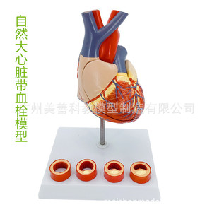 Stent cardiaque, bypass des artères coronaires, chirurgie ouverte de la valve cardiaque, thrombose humaine, démonstration de la structure cardiaque et vasculaire - Product Image 2