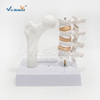 Modelo de Lesión de Osteoporosis en 2 Partes: Columna Vertebral y Fémur Proximal Patológicos, PVC Pintado a Mano, Ideal para la Educación del Paciente