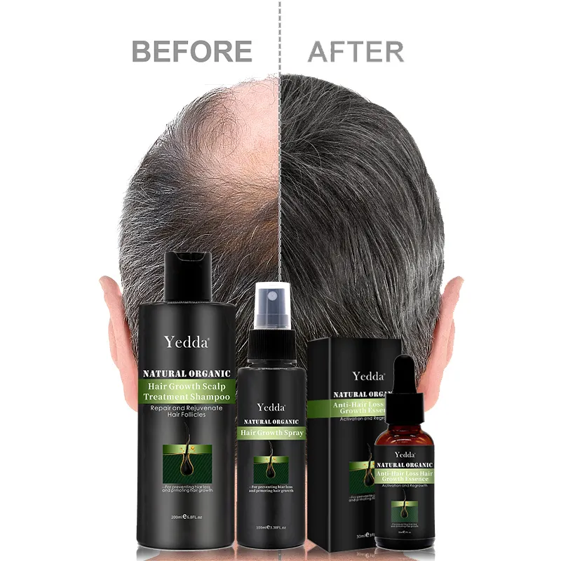 Hair Loss Sets Anti Hair Loss Treatment Serum 30ml Hair Growth Oil for Men and Women