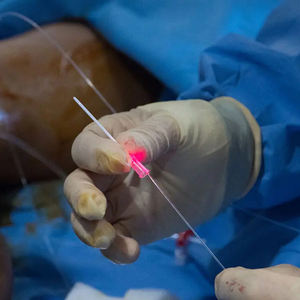 Minimamente invasiva 980 nm 1470nm Varizes EVLT EVLA Endovenosa veia Laser remoção fibra - Product Image 6