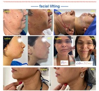 Certification CE 980nm 60w Machine de lipolyse laser liposuccion amincissante Endolaser Lifting du visage