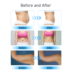 Mới nhất xách tay 8mm 13mm Lipo cơ thể Giảm béo máy liposonixeing - Product Image 5