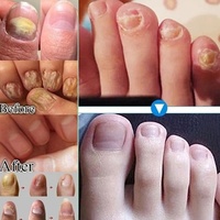 Sérum Anti-Mycose Ongles 7 Jours Marque Blanche Traitement et Réparation Mains Pieds Gel Anti-infectieux