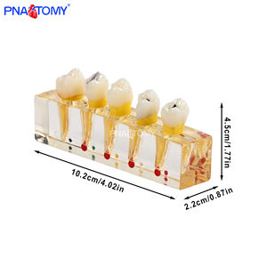 PNATOMY, modelo terapéutico patológico Dental de 5 componentes, muestra lesiones de caries, pulpa necrótica, absceso apical de plástico - Product Image 3